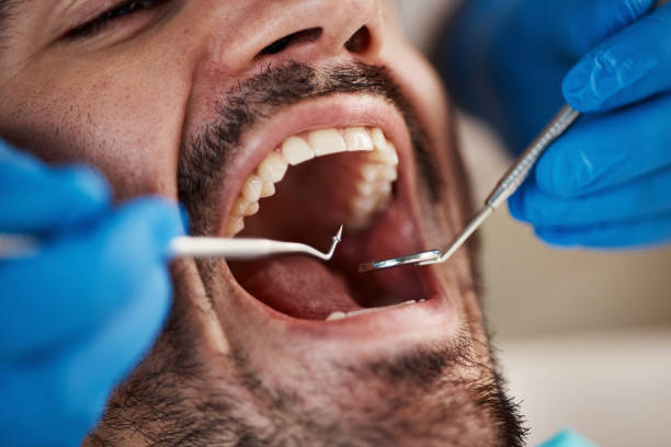 Best Emergency Treatment for Dental Infections or Abscesses in Spanish Fork, UT