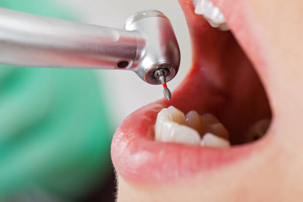 Best Emergency Treatment for Dental Infections or Abscesses in Spanish Fork, UT